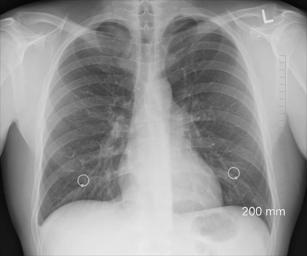 Mesothelioma Latency Periods
